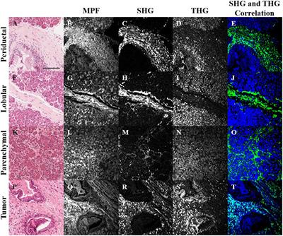 Characterization of Pancreatic Cancer Tissue Using Multiphoton Excitation Fluorescence and Polarization-Sensitive Harmonic Generation Microscopy